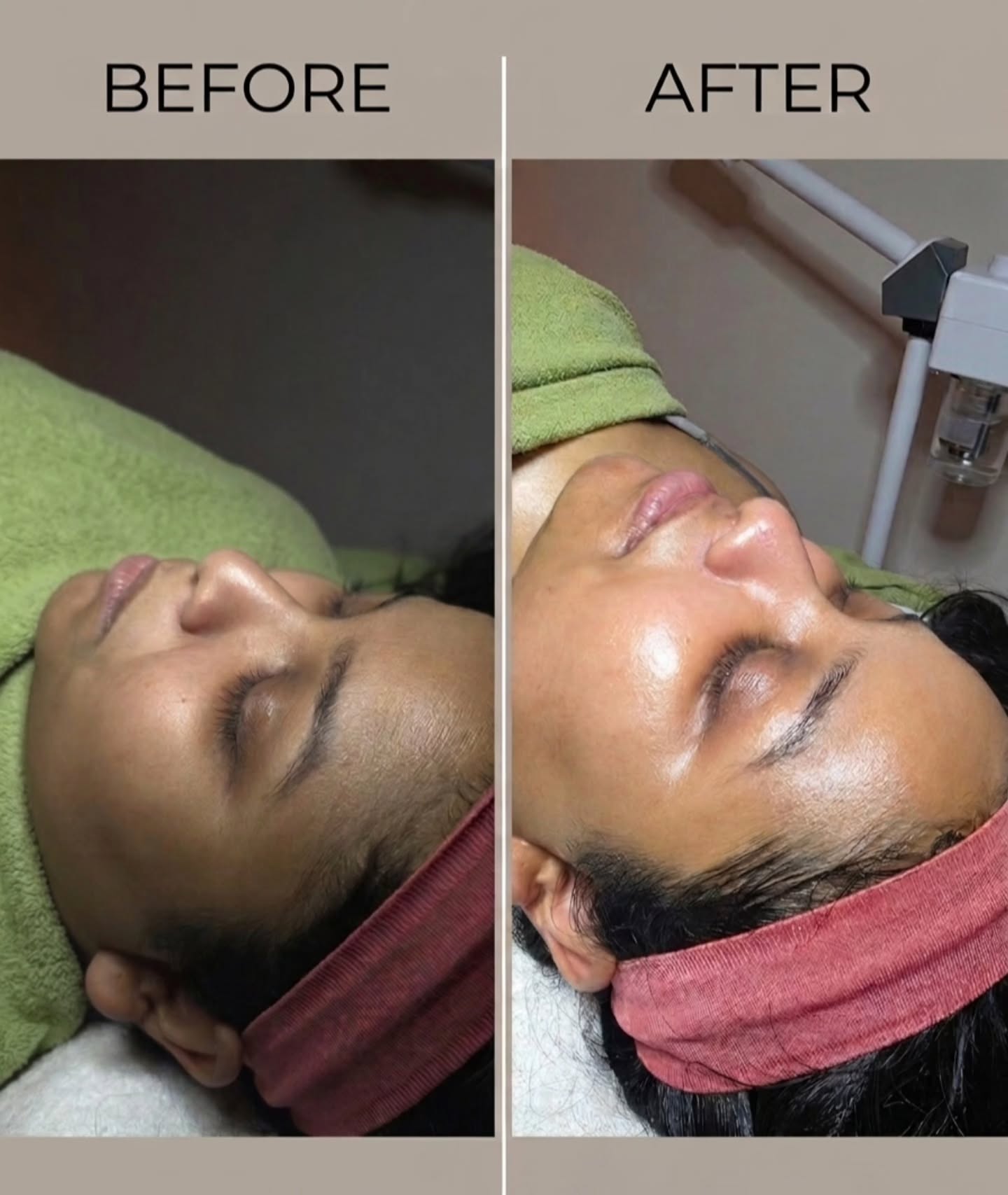 Dehydrated skin has met its match! We combined deep hydration with intensive brightening to restore this complexion's bounce and luminosity.  Ah the dew!!!! #facial